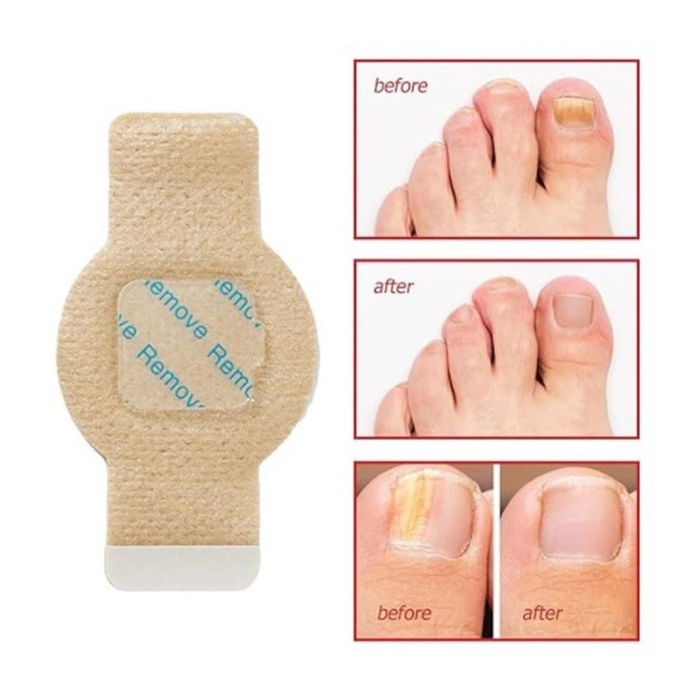 Fungal Nail Patches (Yellow) - Image 4