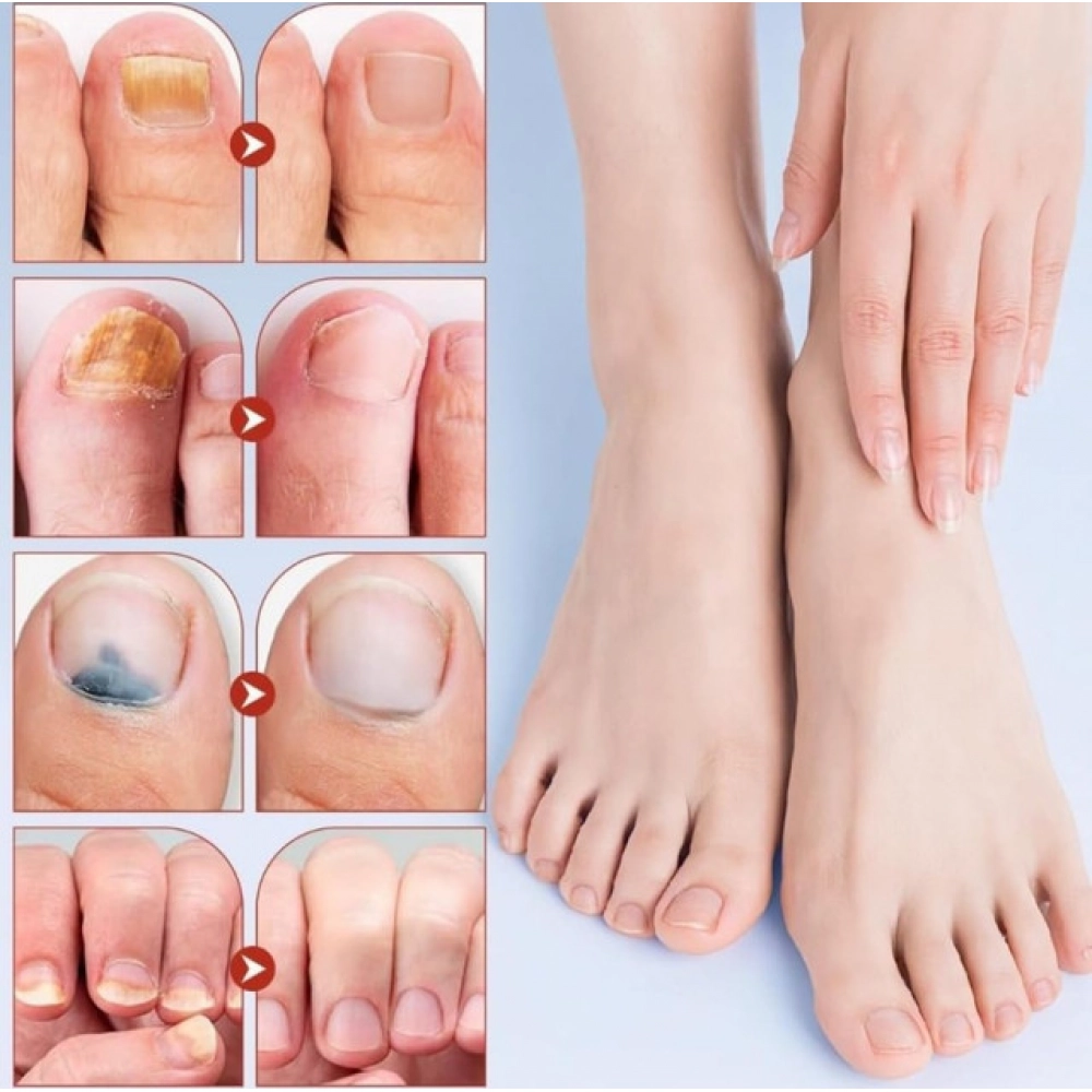 Fungal Nail Patches (Yellow) - Image 3
